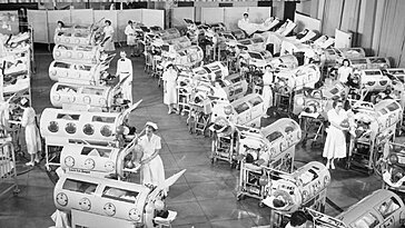 Le vaccin contre la polio fête ses 70 ans, illustré par des images de la dernière épidémie aux USA